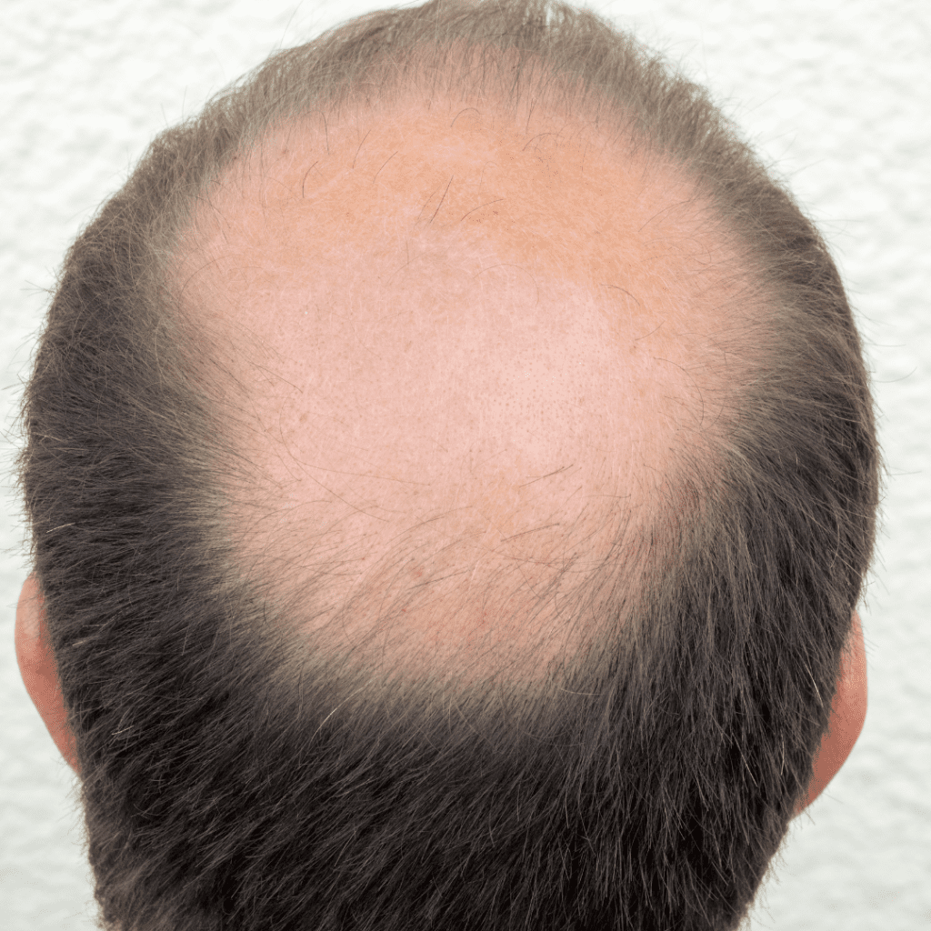 No Shave Hair Transplant - American Mane Hair Restoration