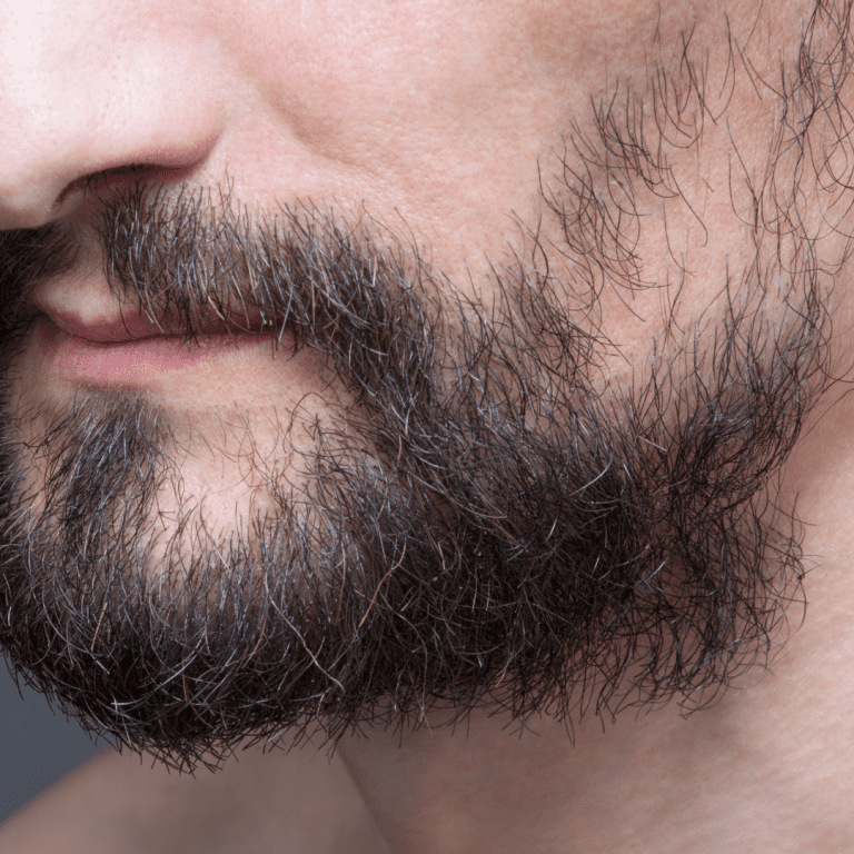 Beard Implants - American Mane Hair Restoration