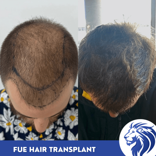 how much is fue hair transplant