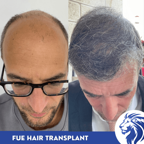 Before and after hair transplant