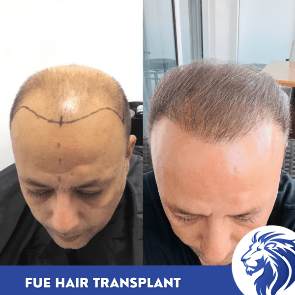fue hair transplant timeline