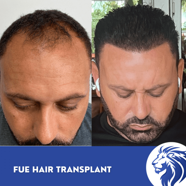 fue hair transplant timeline